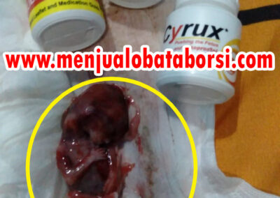 Pilihan 7 Obat Aborsi Paling Aman Menurut Rekomendasi Medis