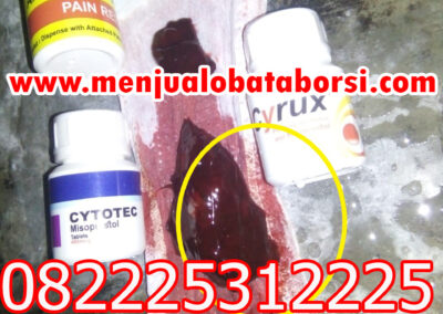 Bedanya Obat Aborsi Cytote Misoprostol dan Gastrul yang perlu kamu tahu